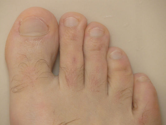Wie man die Fußpilz Behandlung effektiv unterstützt