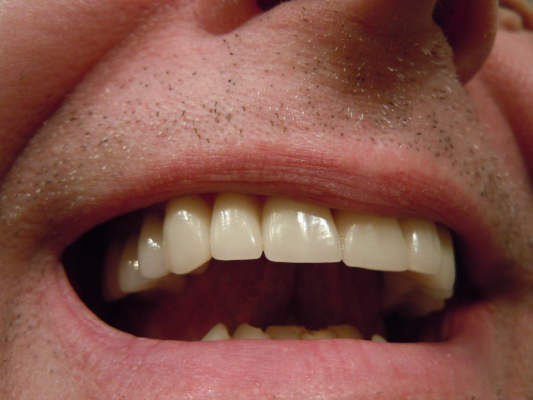 Unser Tipp für strahlend weiße Zähne